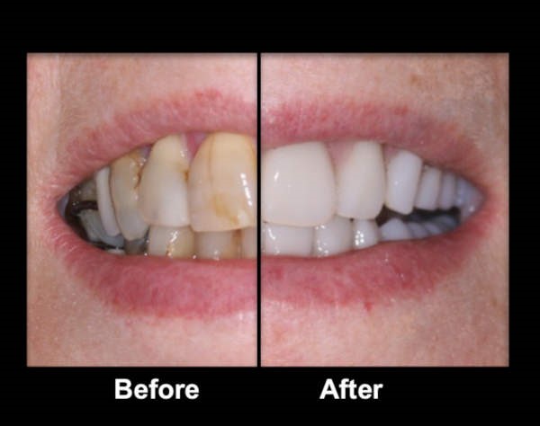 Getting Dentures Process Houston TX 77019